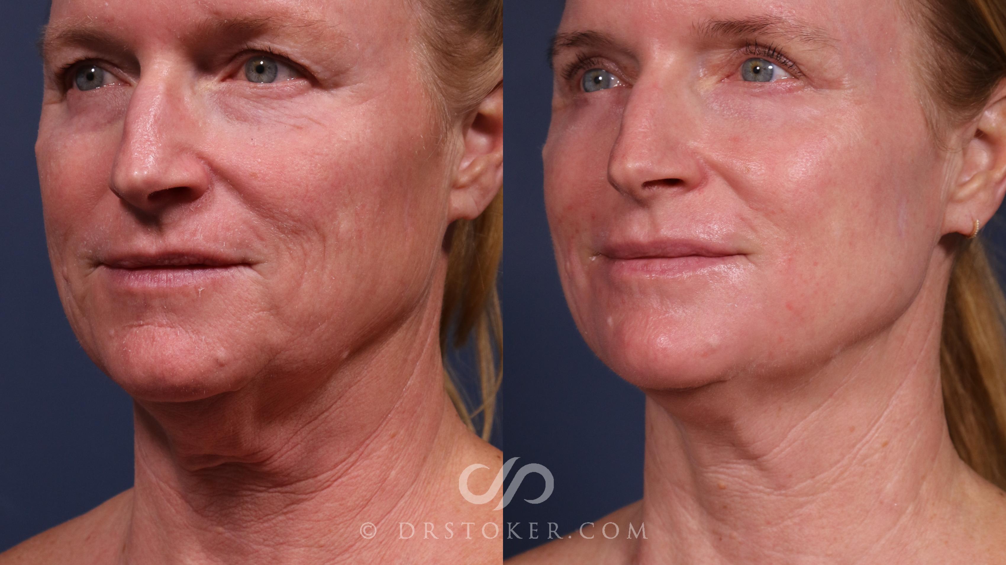 Before & After Laser Skin Resurfacing  Case 2561 Left Oblique View in Los Angeles, CA