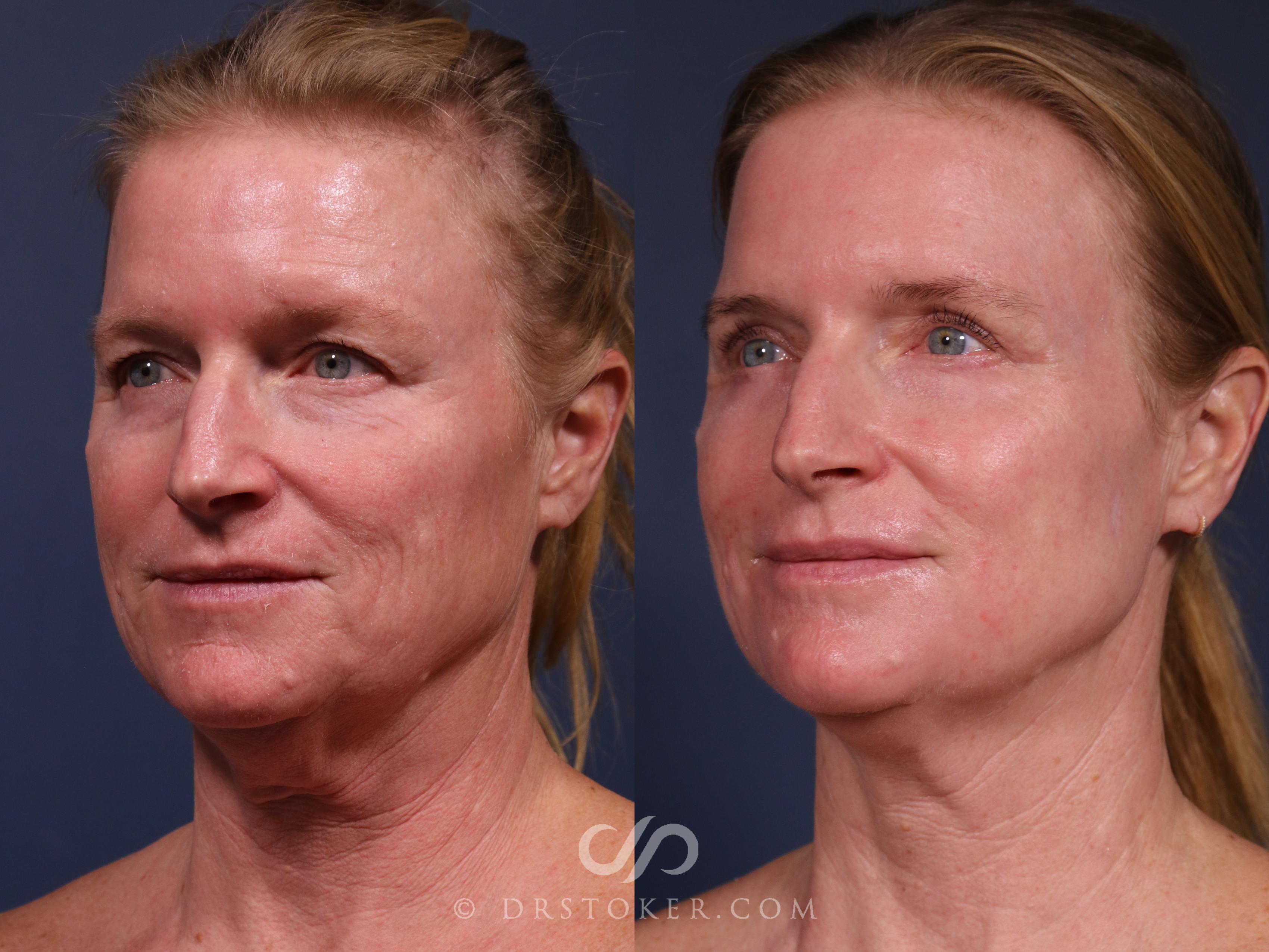 Before & After Laser Skin Resurfacing  Case 2561 Left Side View in Los Angeles, CA