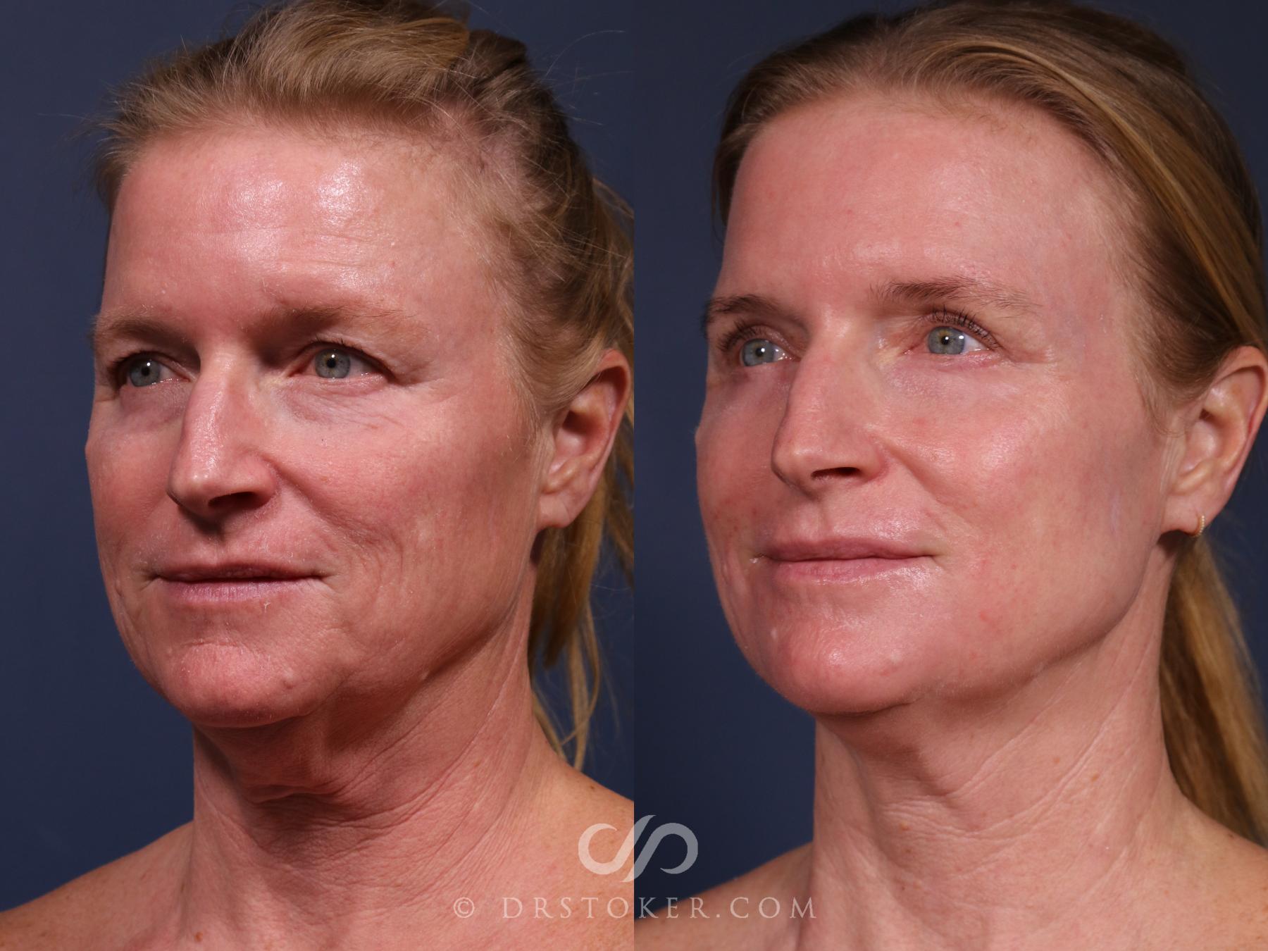 Before & After Laser Skin Resurfacing  Case 2561 Left Side View in Los Angeles, CA