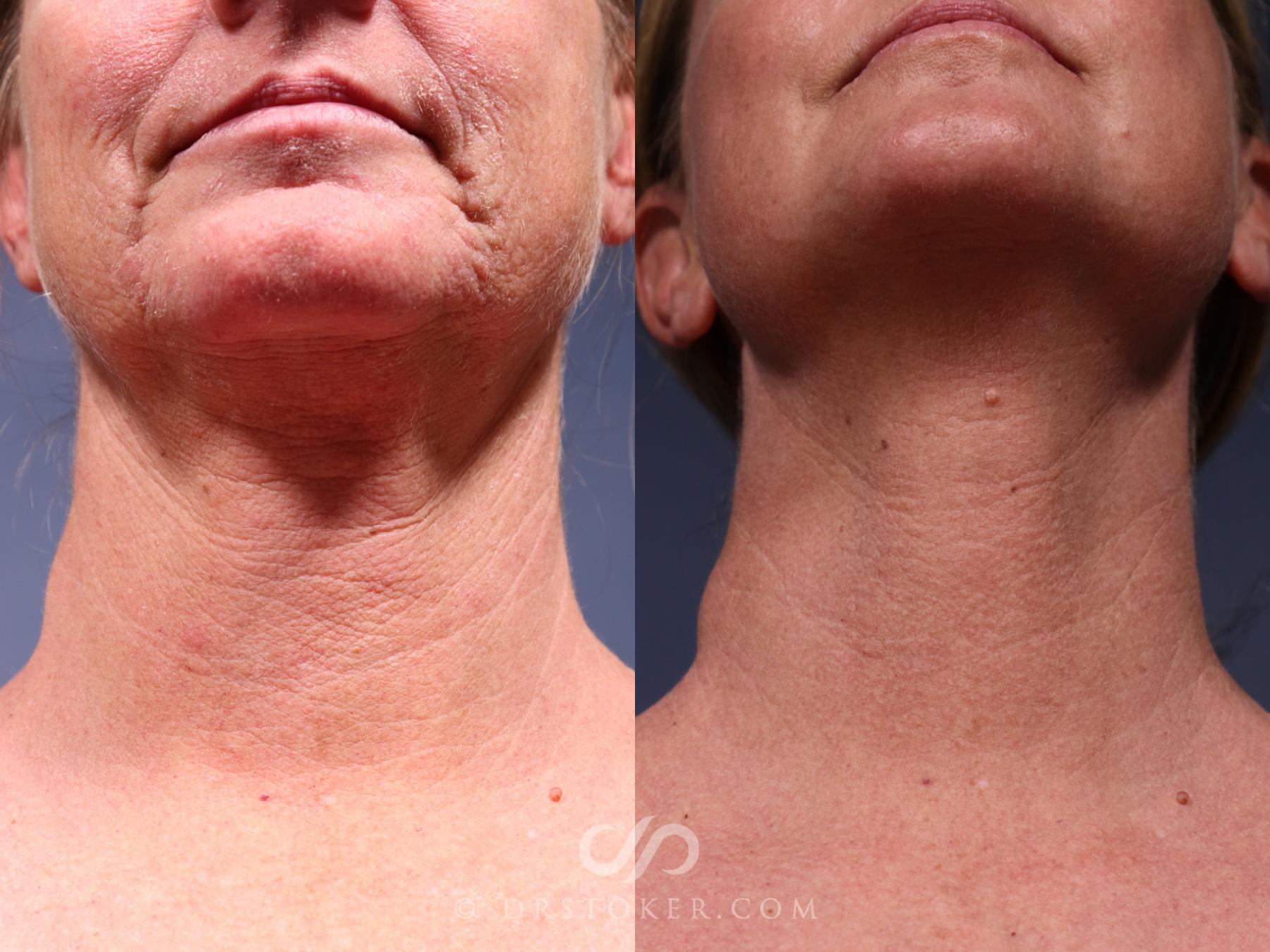 Before & After Laser Skin Resurfacing  Case 2562 Front View in Los Angeles, CA