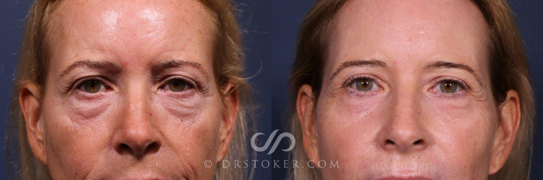 Before & After Laser Skin Resurfacing  Case 2563 Front Eyes View in Los Angeles, CA