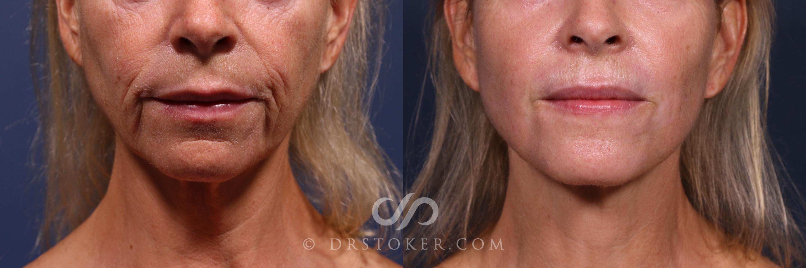 Before & After Laser Skin Resurfacing  Case 2563 Front Mouth  View in Los Angeles, CA