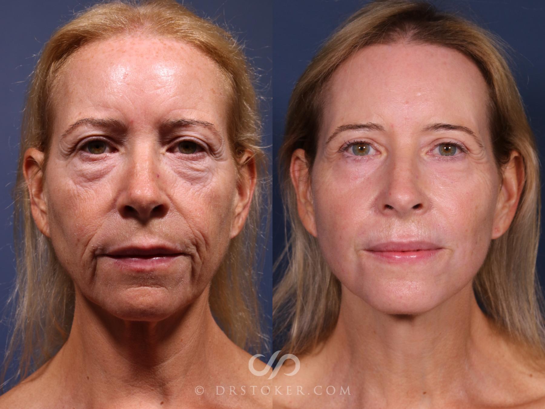 Before & After Laser Skin Resurfacing  Case 2563 Front View in Los Angeles, CA
