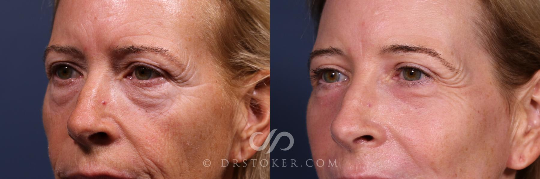 Before & After Laser Skin Resurfacing  Case 2563 Left Oblique Eyes View in Los Angeles, CA