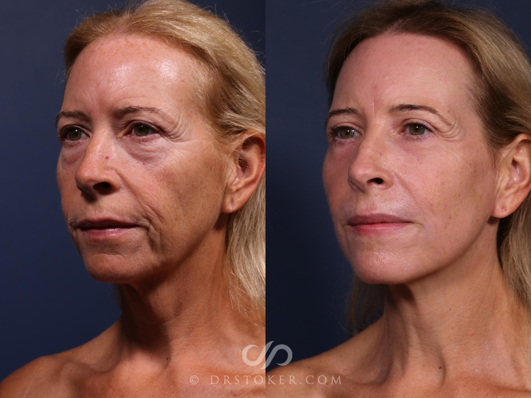 Before & After Laser Skin Resurfacing  Case 2563 Left Oblique View in Los Angeles, CA