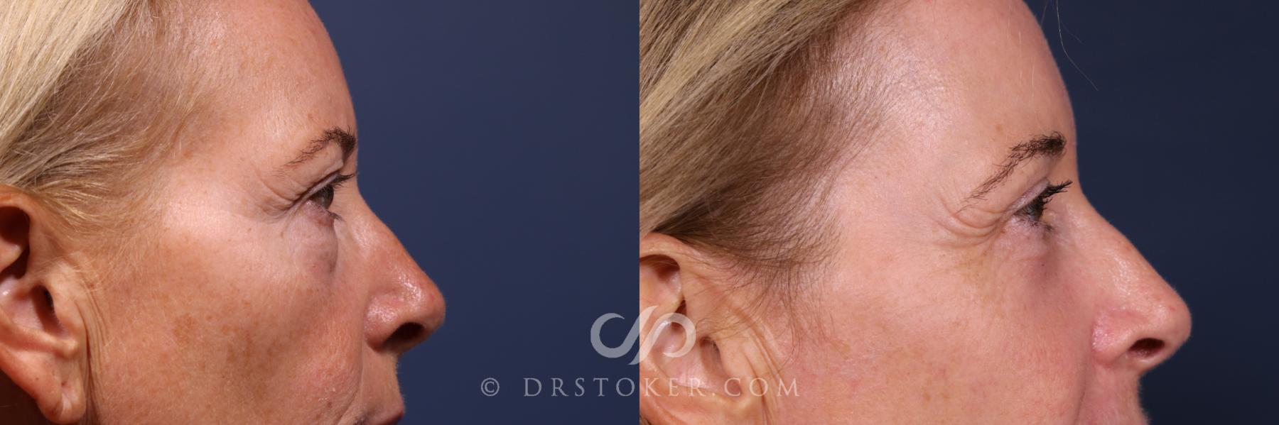 Before & After Laser Skin Resurfacing  Case 2563 Right Eyes View in Los Angeles, CA
