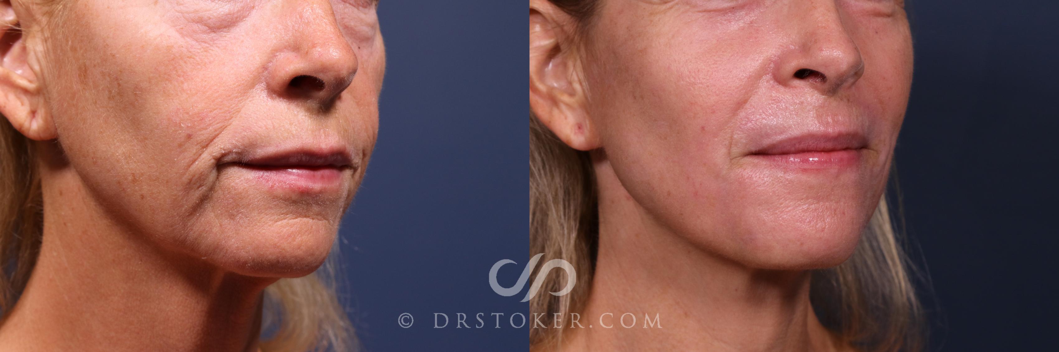 Before & After Laser Skin Resurfacing  Case 2563 Right Mouth View in Los Angeles, CA
