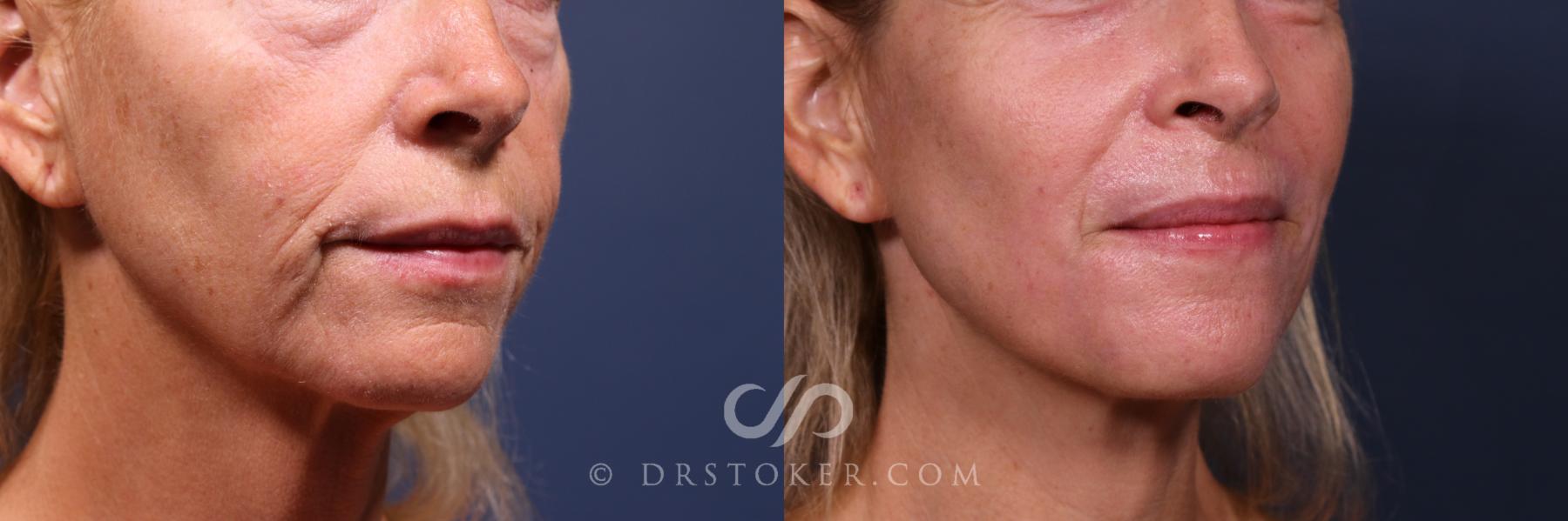 Before & After Laser Skin Resurfacing  Case 2563 Right Mouth View in Los Angeles, CA