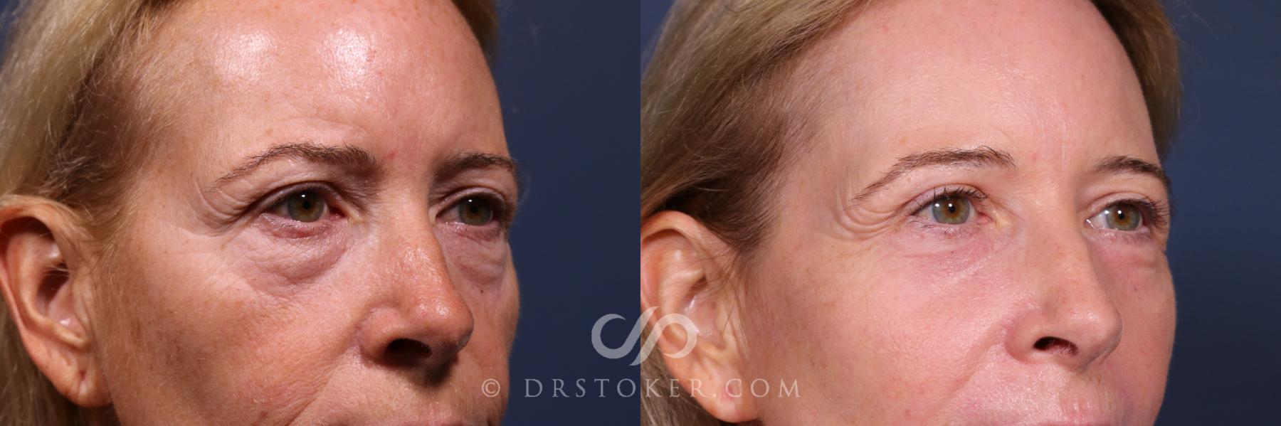 Before & After Laser Skin Resurfacing  Case 2563 Right Oblique Eyes View in Los Angeles, CA