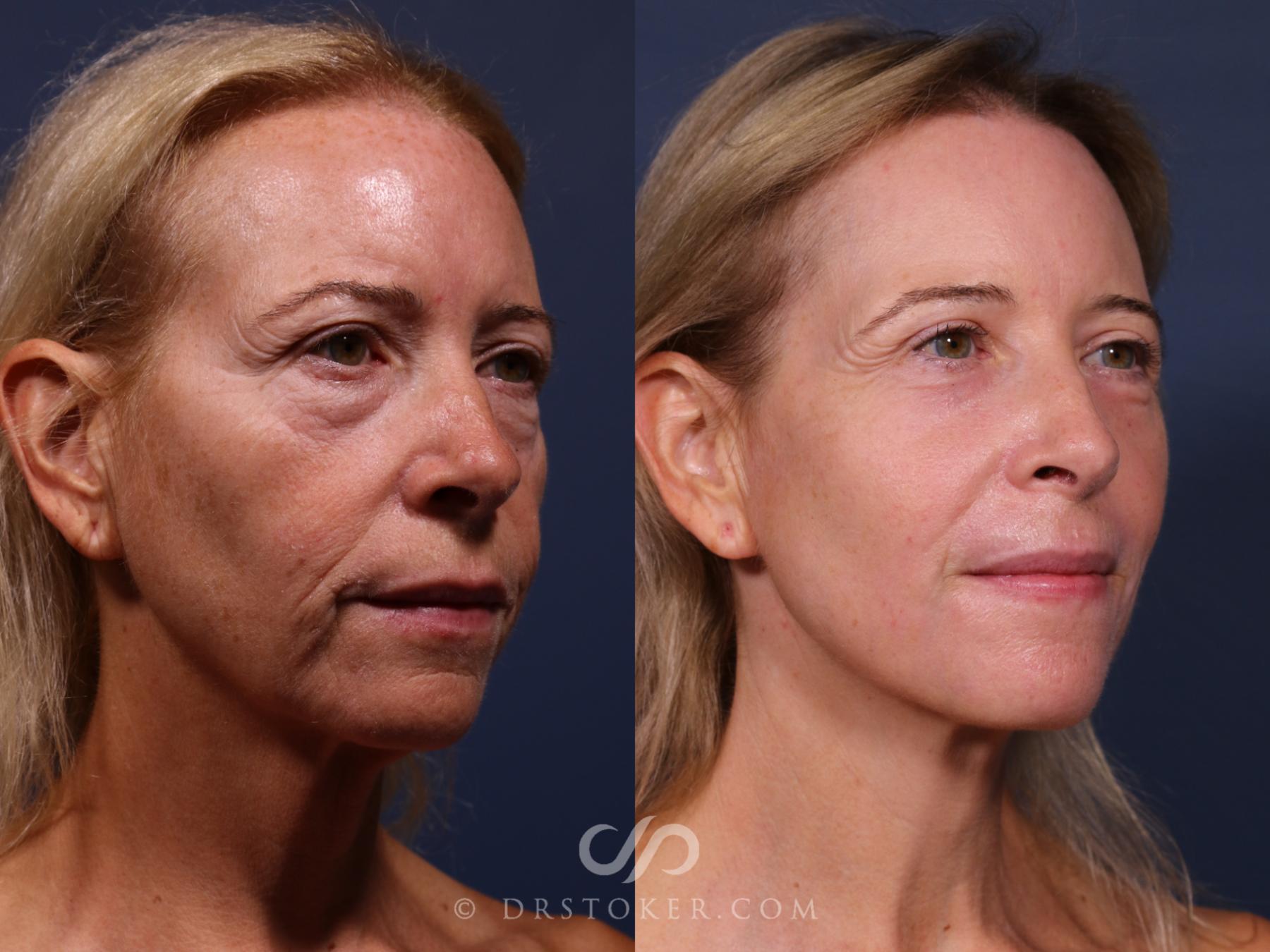 Before & After Laser Skin Resurfacing  Case 2563 Right Oblique View in Los Angeles, CA
