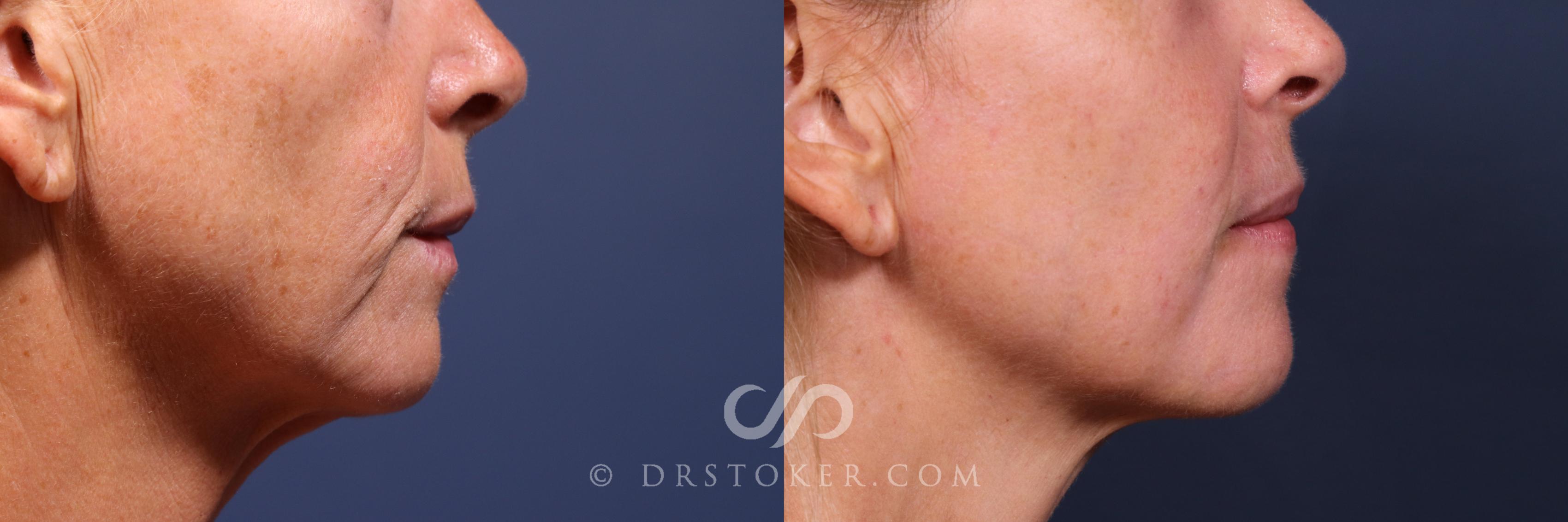Before & After Laser Skin Resurfacing  Case 2563 Right Side Mouth View in Los Angeles, CA