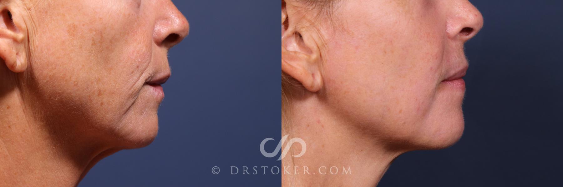 Before & After Laser Skin Resurfacing  Case 2563 Right Side Mouth View in Los Angeles, CA