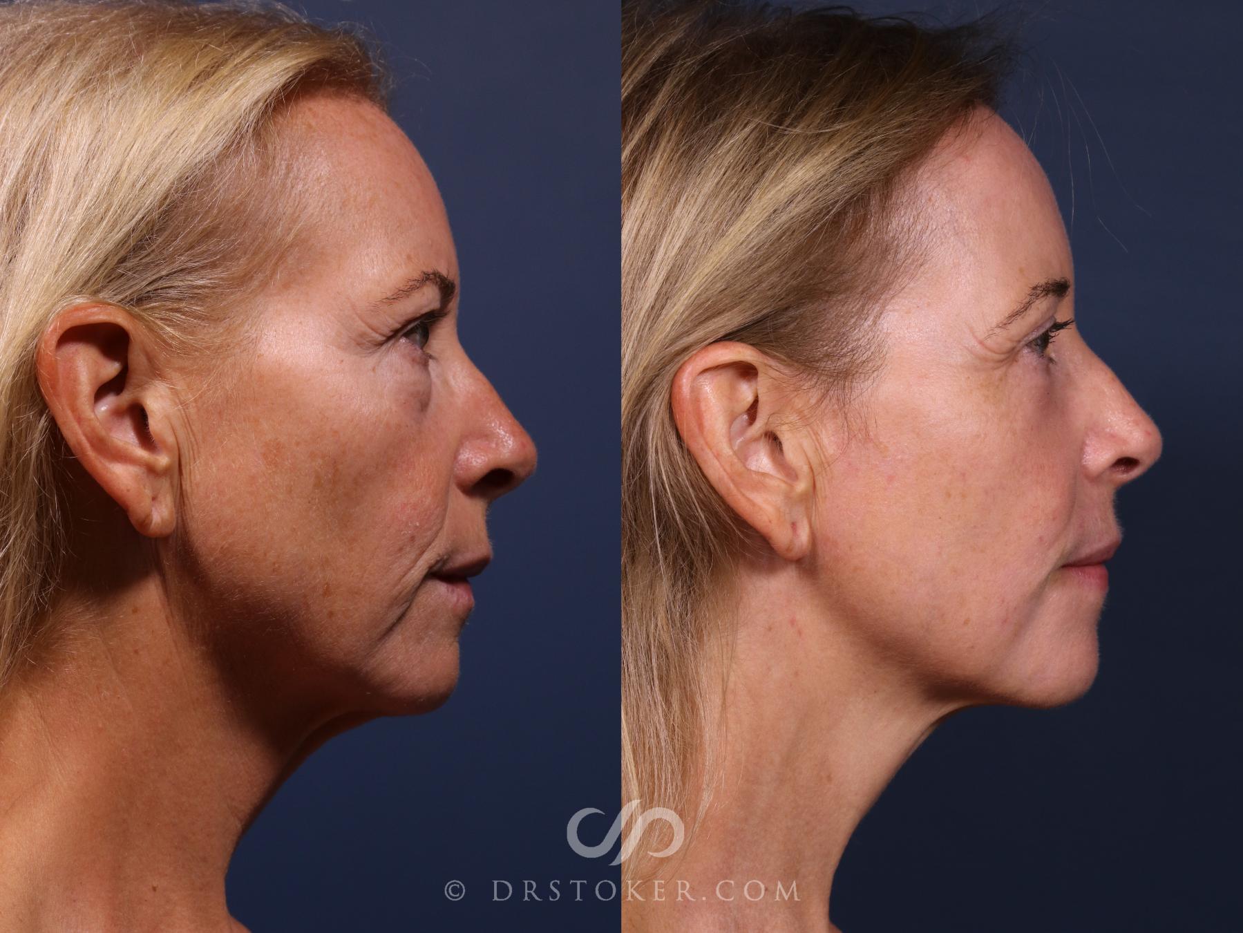 Before & After Laser Skin Resurfacing  Case 2563 Right Side View in Los Angeles, CA