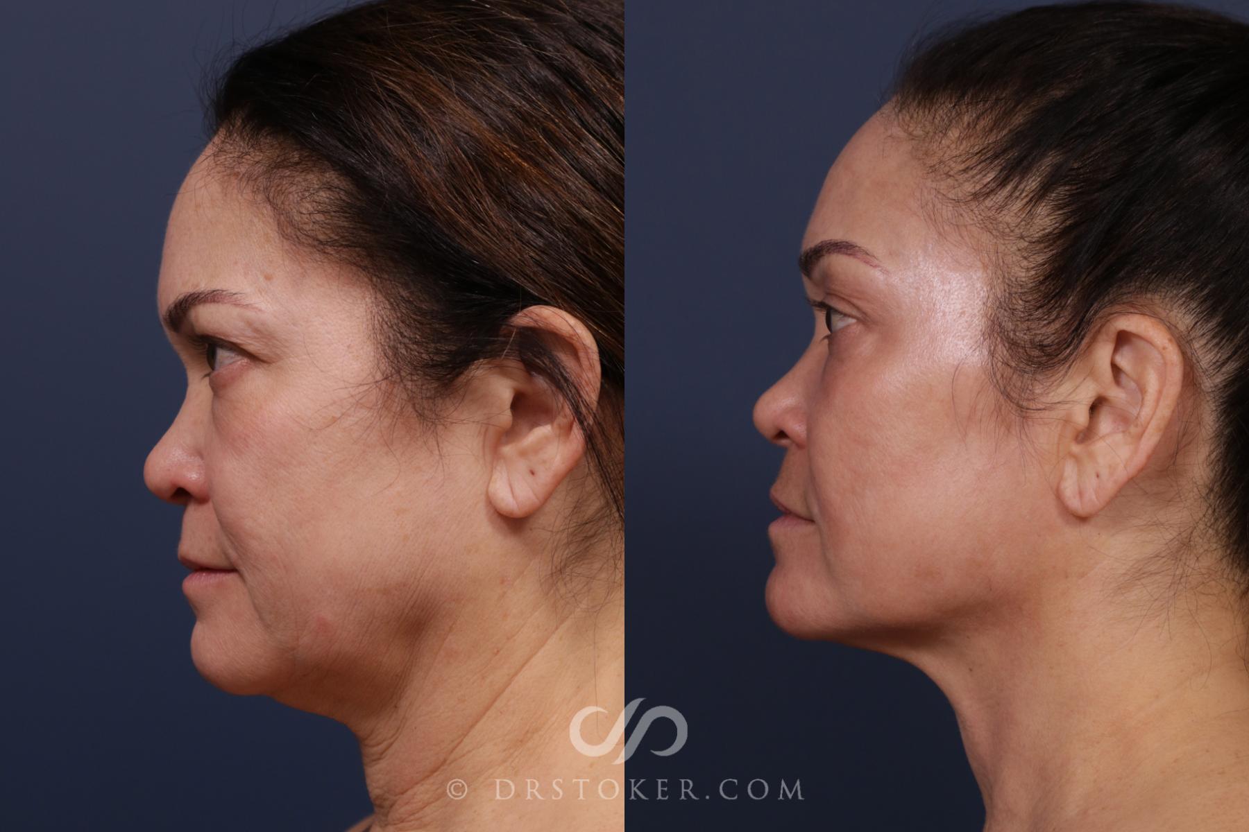 Before & After Laser Skin Resurfacing  Case 2571 Left Side View in Los Angeles, CA
