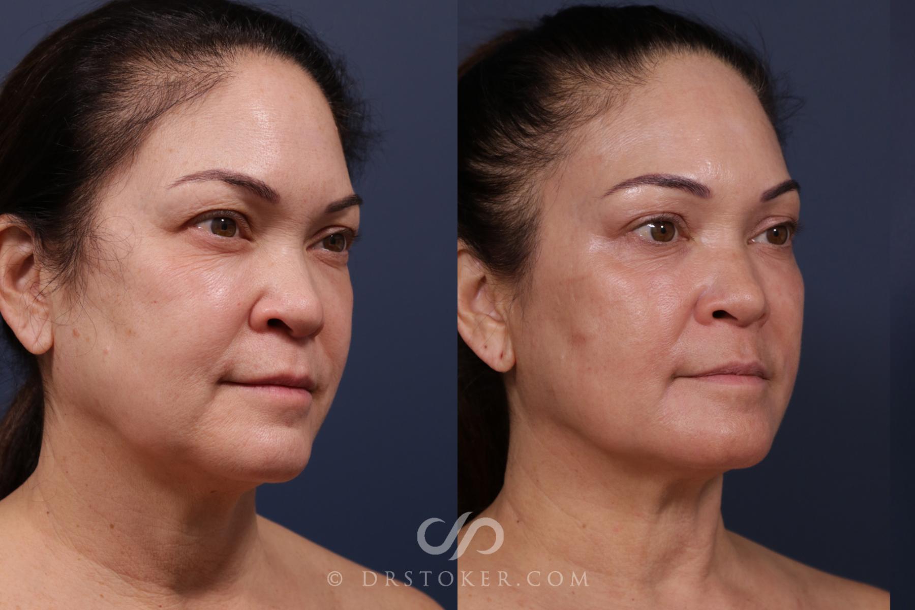 Before & After Laser Skin Resurfacing  Case 2571 Right Oblique View in Los Angeles, CA