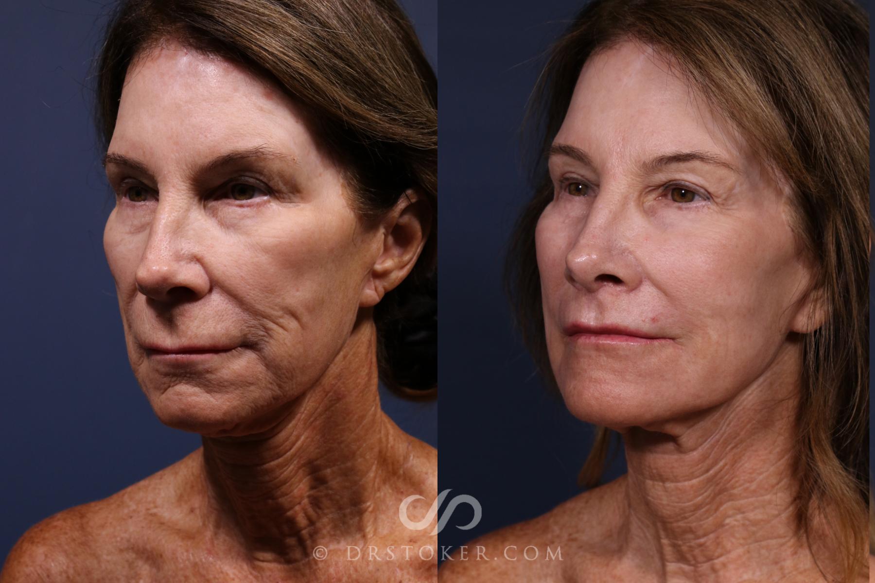 Before & After Laser Skin Resurfacing  Case 2577 Left Oblique View in Los Angeles, CA