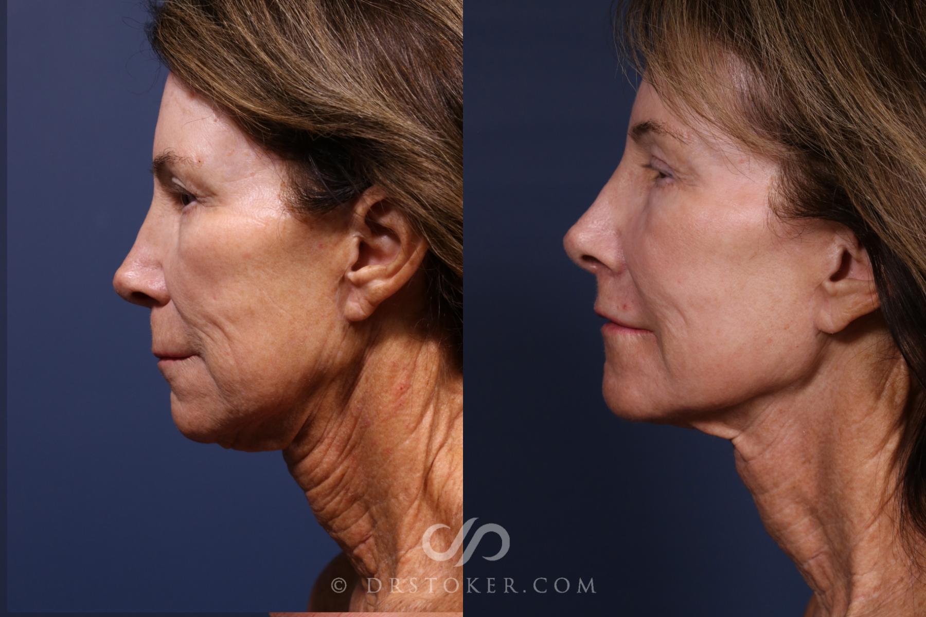 Before & After Laser Skin Resurfacing  Case 2577 Left Side View in Los Angeles, CA