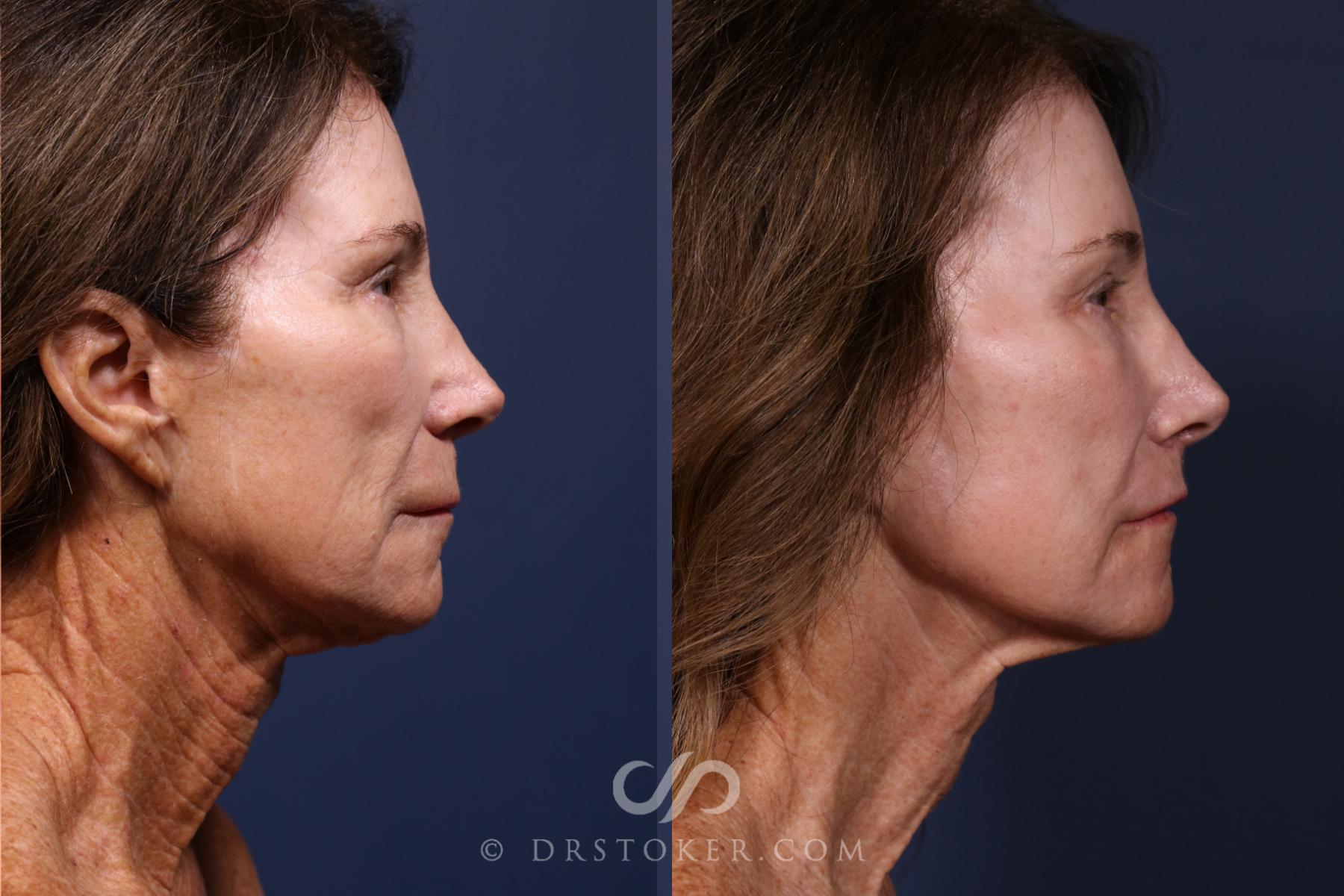 Before & After Laser Skin Resurfacing  Case 2577 Right Side View in Los Angeles, CA
