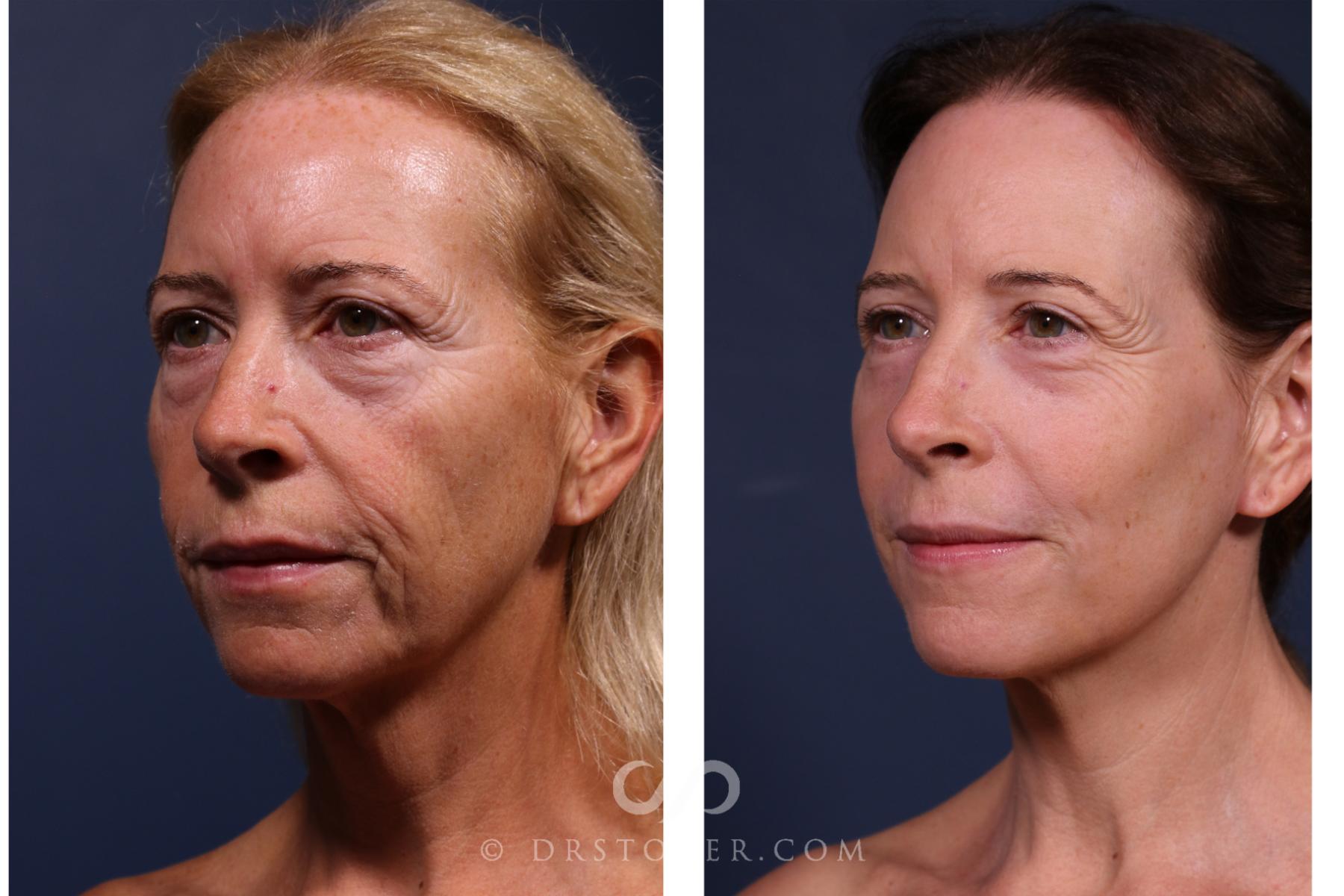 Before & After Laser Skin Resurfacing  Case 2637 Left Oblique View in Los Angeles, CA
