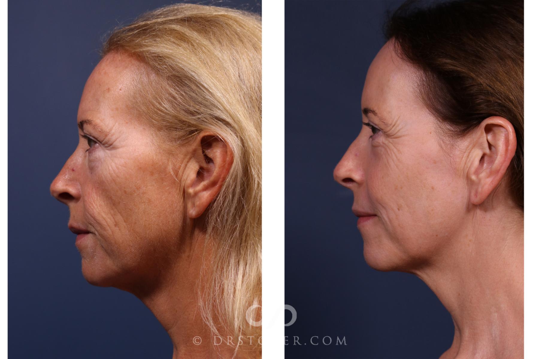 Before & After Laser Skin Resurfacing  Case 2637 Left Side View in Los Angeles, CA