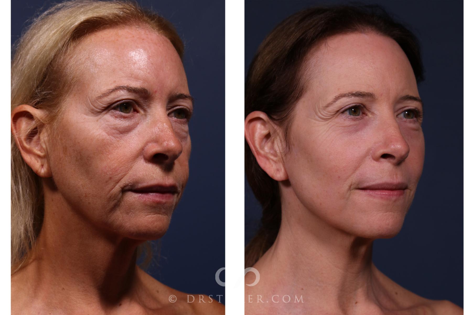 Before & After Laser Skin Resurfacing  Case 2637 Right Oblique View in Los Angeles, CA