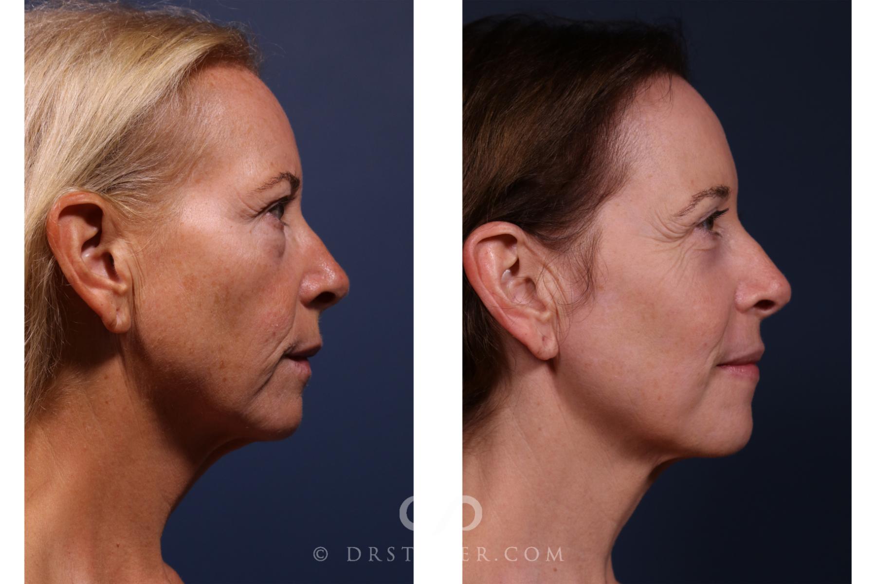 Before & After Laser Skin Resurfacing  Case 2637 Right Side View in Los Angeles, CA