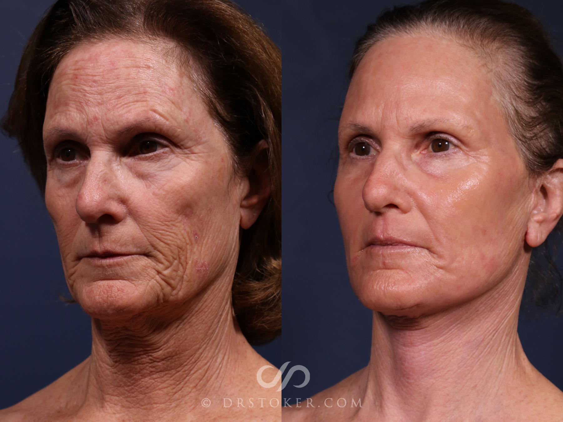 Before & After Laser Skin Resurfacing  Case 2665 Left Oblique View in Los Angeles, CA