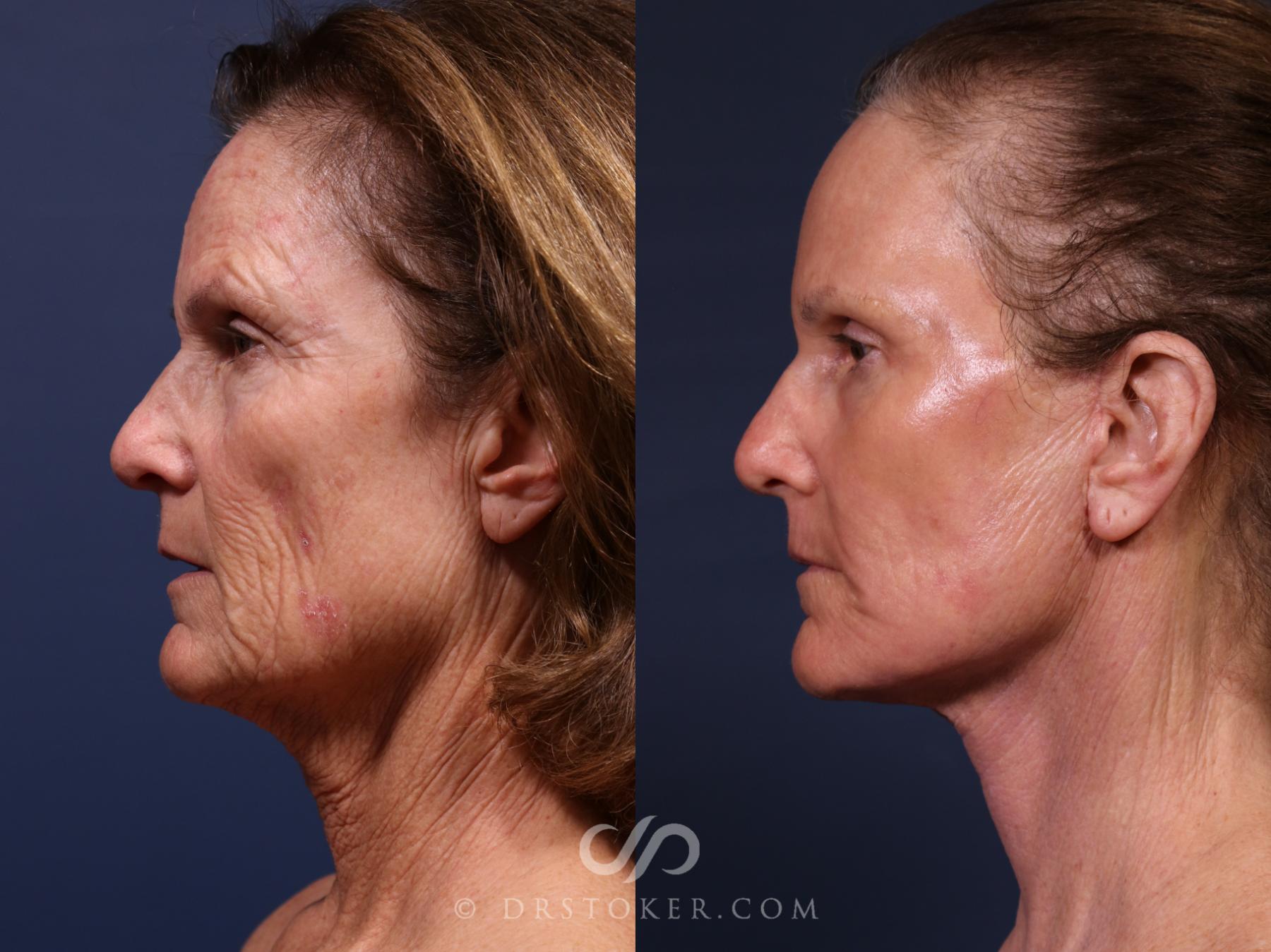 Before & After Laser Skin Resurfacing  Case 2665 Left Side View in Los Angeles, CA