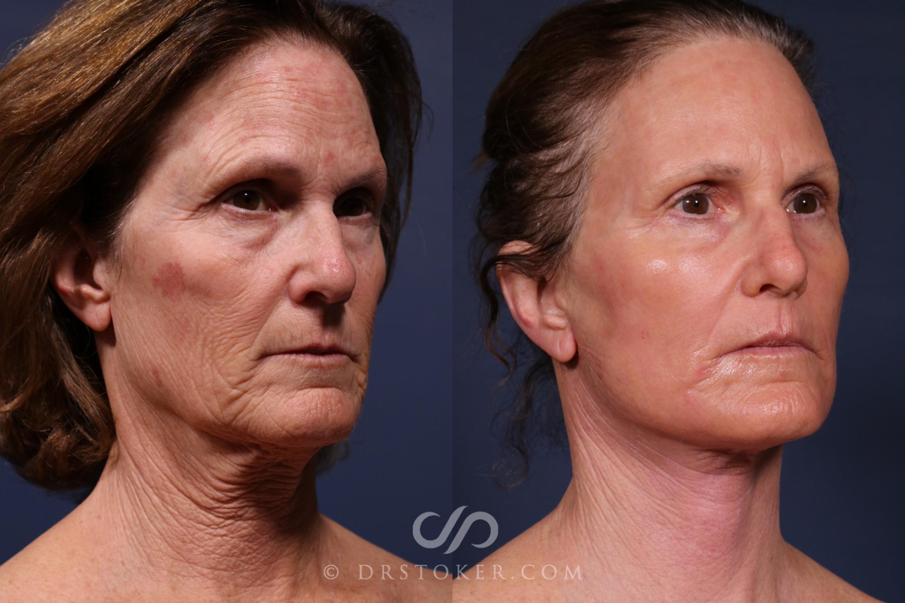 Before & After Laser Skin Resurfacing  Case 2665 Right Oblique View in Los Angeles, CA