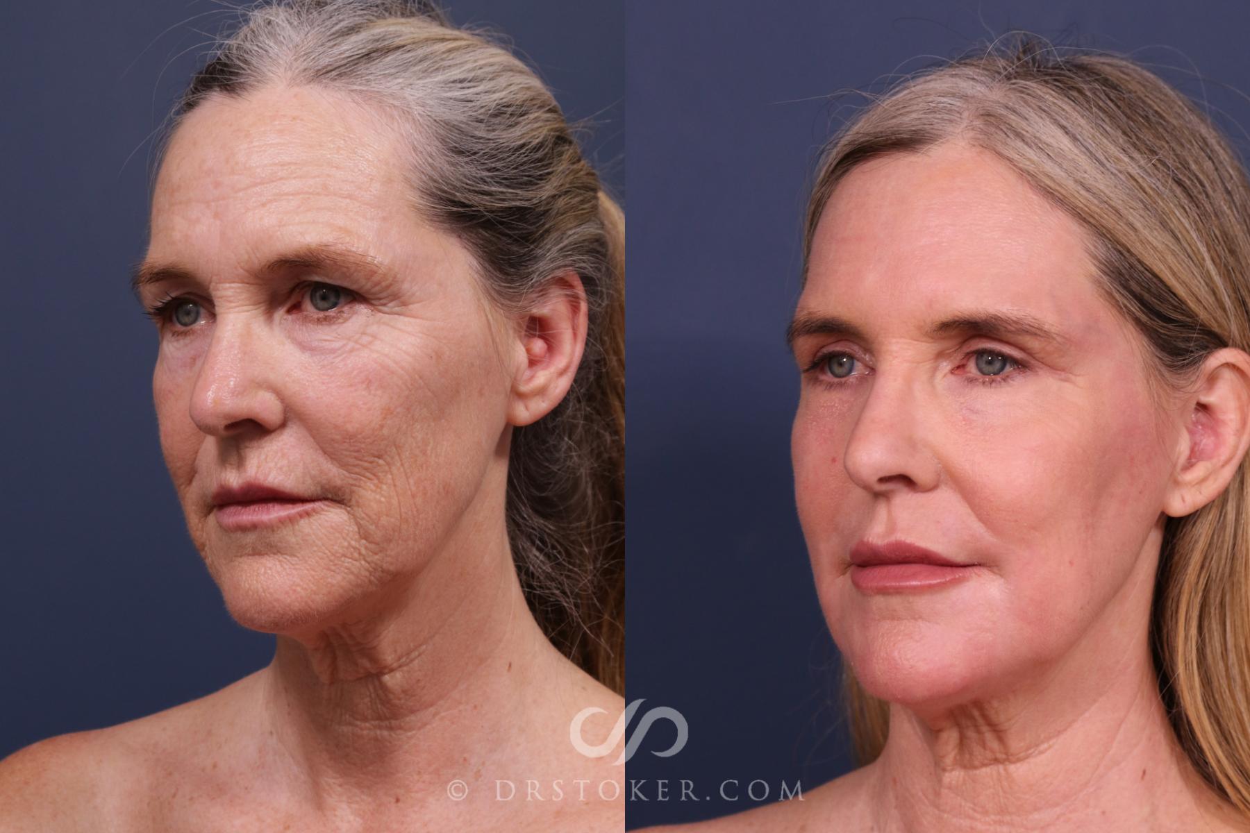 Before & After Laser Skin Resurfacing  Case 2666 Left Oblique View in Los Angeles, CA
