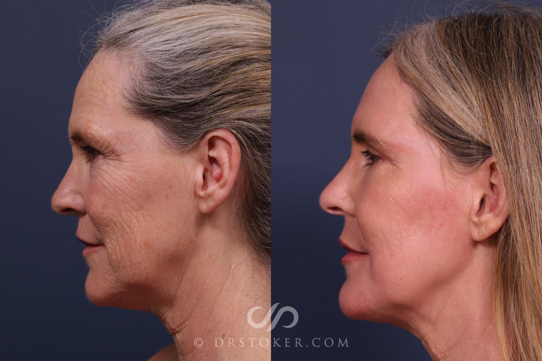 Before & After Laser Skin Resurfacing  Case 2666 Left Side View in Los Angeles, CA