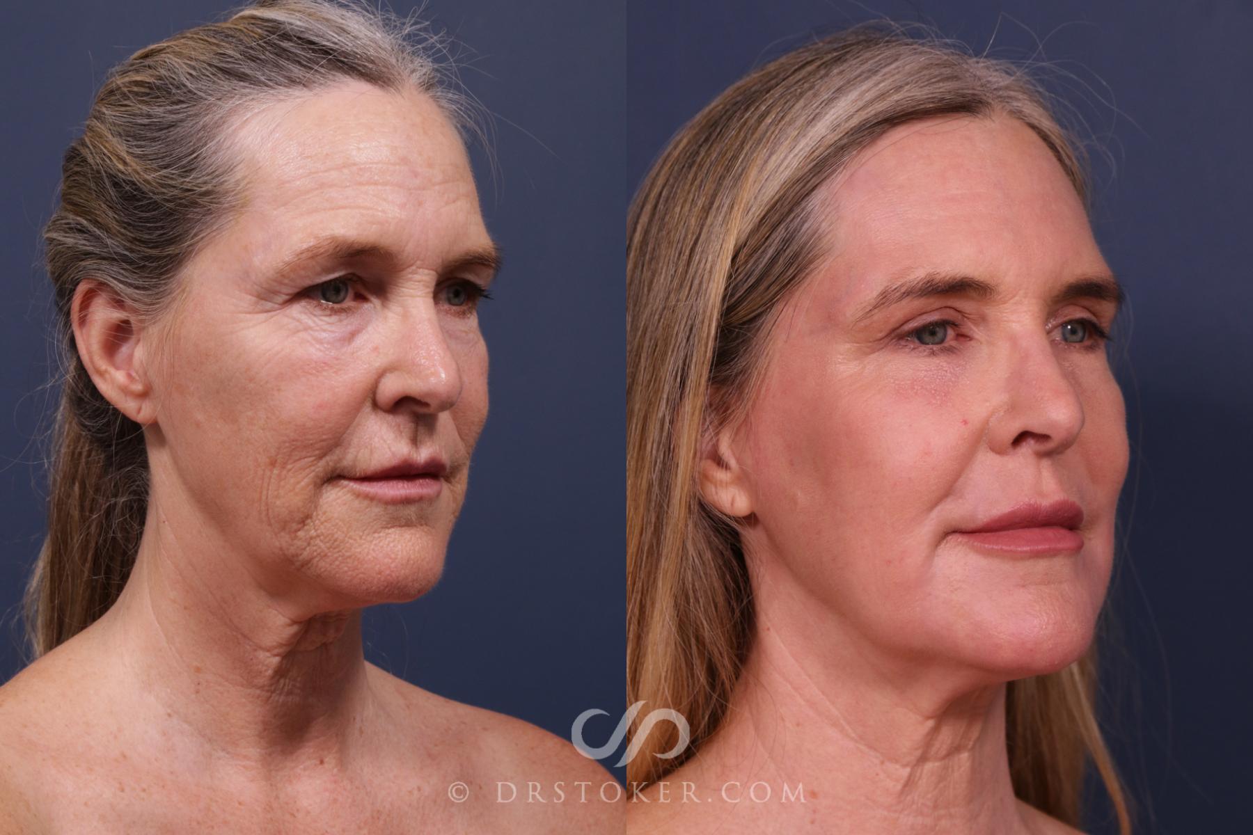 Before & After Laser Skin Resurfacing  Case 2666 Right Oblique View in Los Angeles, CA