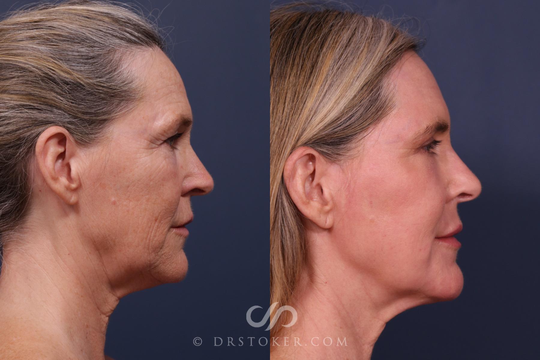 Before & After Laser Skin Resurfacing  Case 2666 Right Side View in Los Angeles, CA