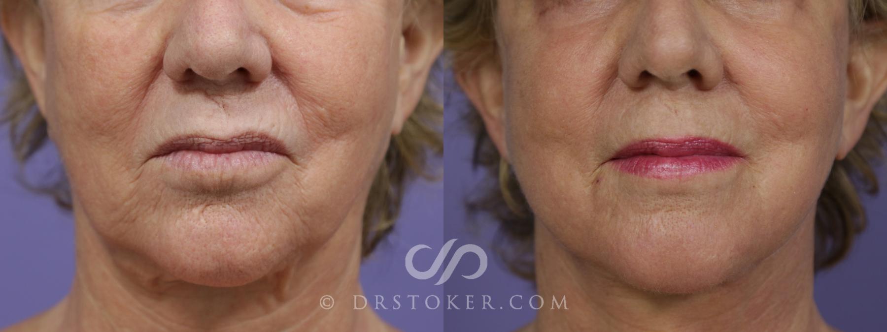 Before & After Laser Skin Resurfacing (Mouth) Case 1307 View #1 View in Los Angeles, CA