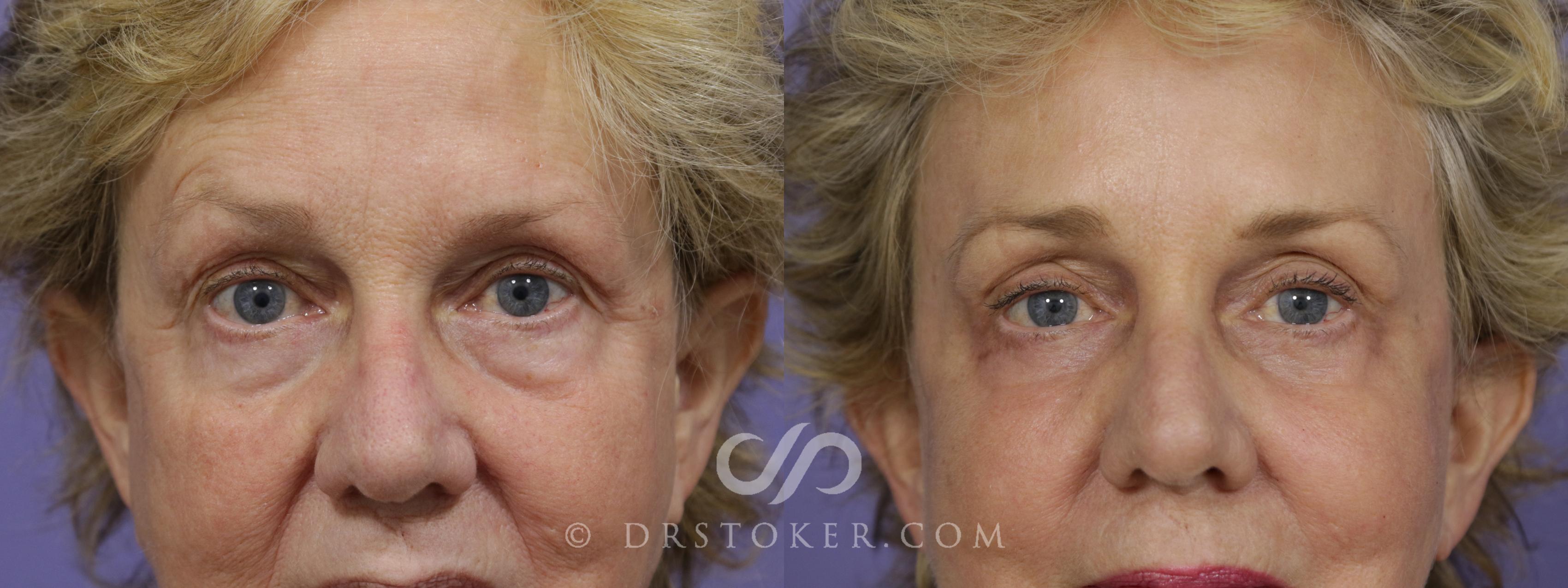 Before & After Laser Skin Resurfacing Case 1308 View #1 View in Los Angeles, CA