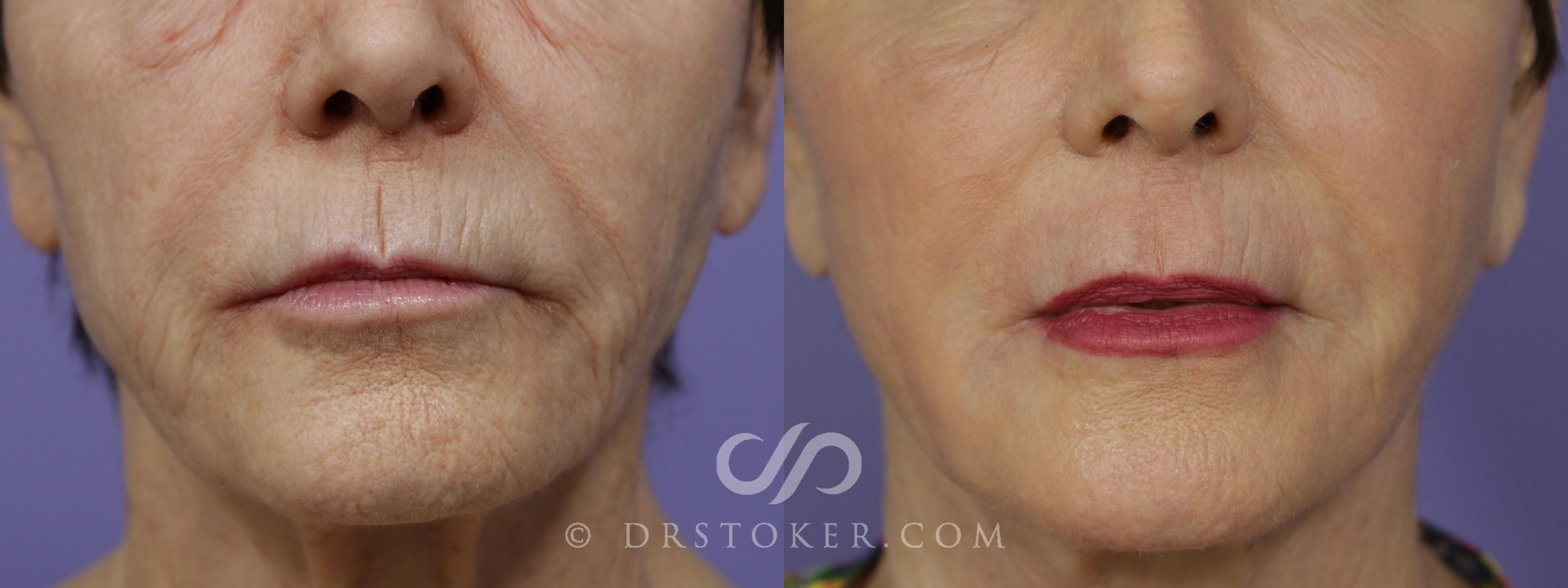 Before & After Laser Skin Resurfacing Case 1310 View #1 View in Los Angeles, CA