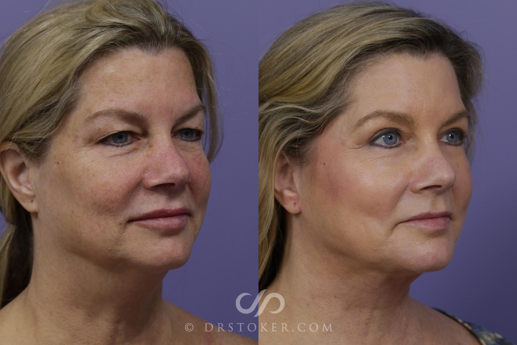Before & After Laser Skin Resurfacing Case 1430 View #2 View in Los Angeles, CA