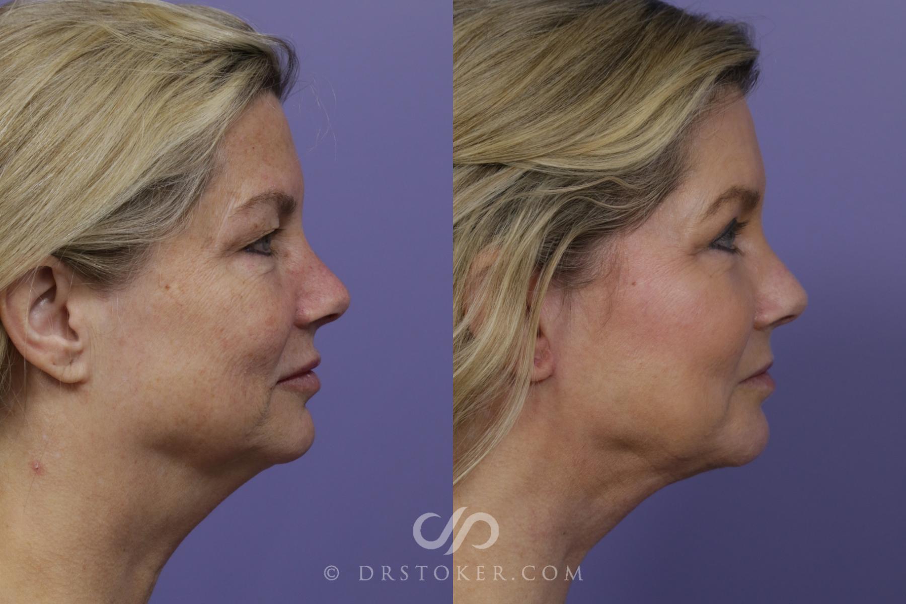 Before & After Chin Augmentation Case 1430 View #3 View in Los Angeles, CA