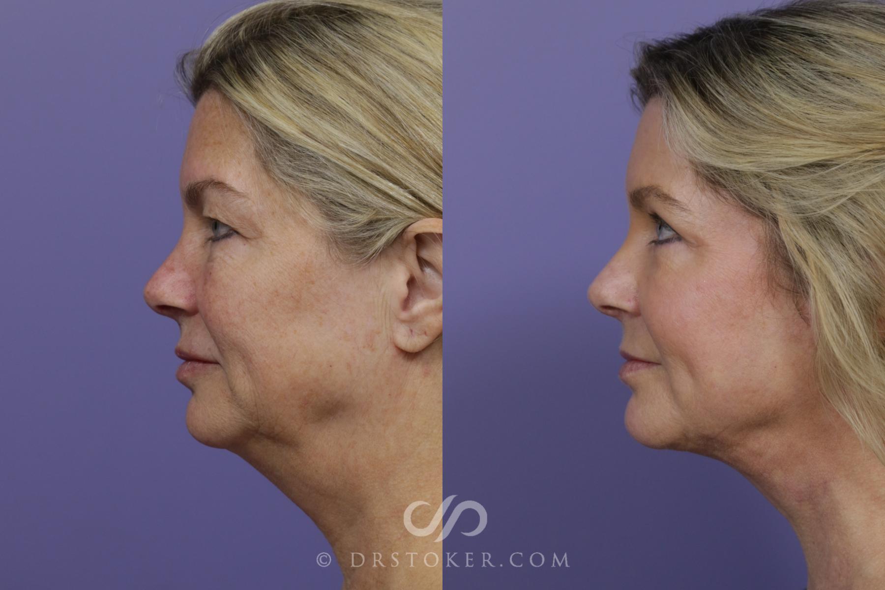 Before & After Laser Skin Resurfacing Case 1430 View #5 View in Los Angeles, CA