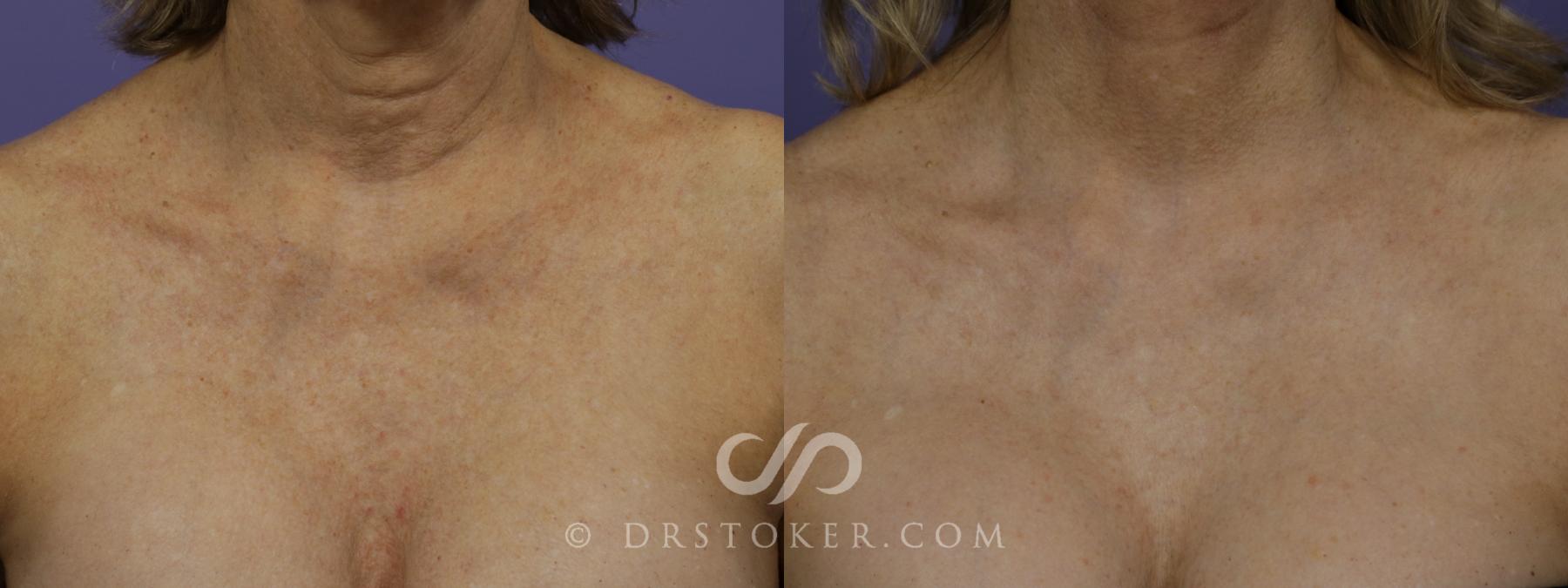 Before & After Laser Skin Resurfacing Case 1442 View #1 View in Los Angeles, CA