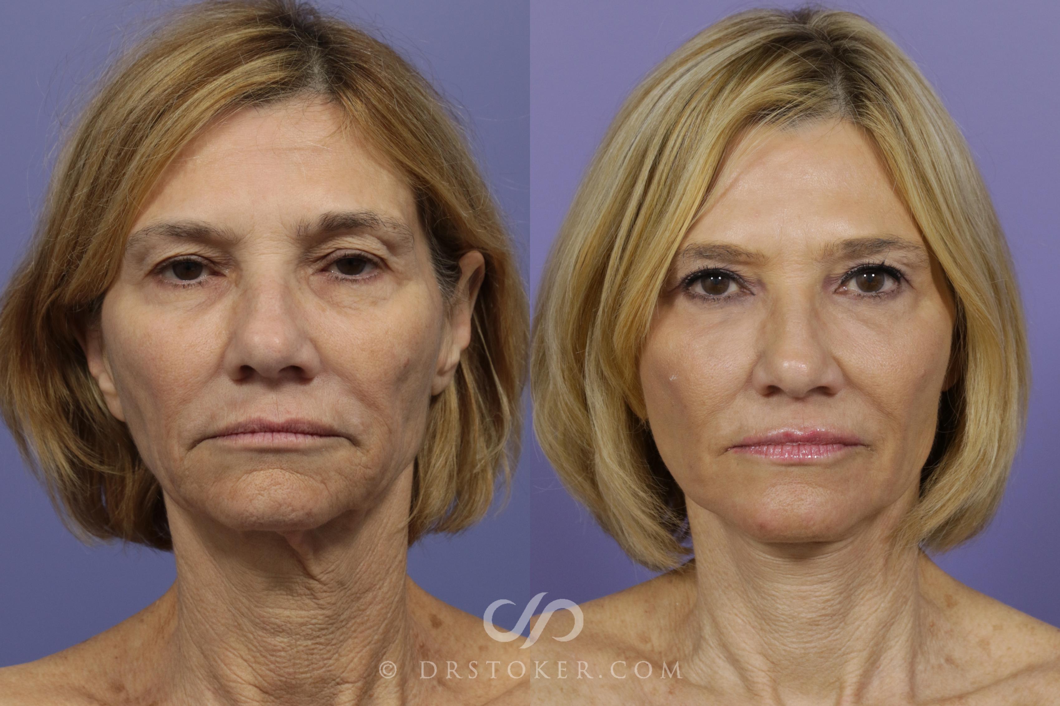 Before & After Laser Skin Resurfacing Case 1443 View #1 View in Los Angeles, CA