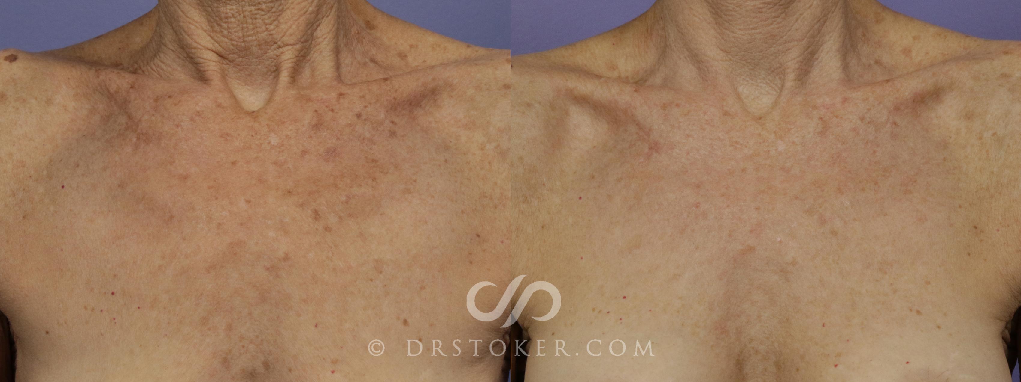 Before & After Laser Skin Resurfacing Case 1445 View #1 View in Los Angeles, CA