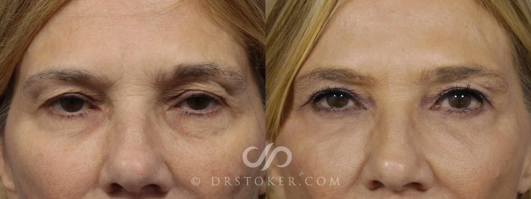 Before & After Laser Skin Resurfacing Case 1446 View #1 View in Los Angeles, CA