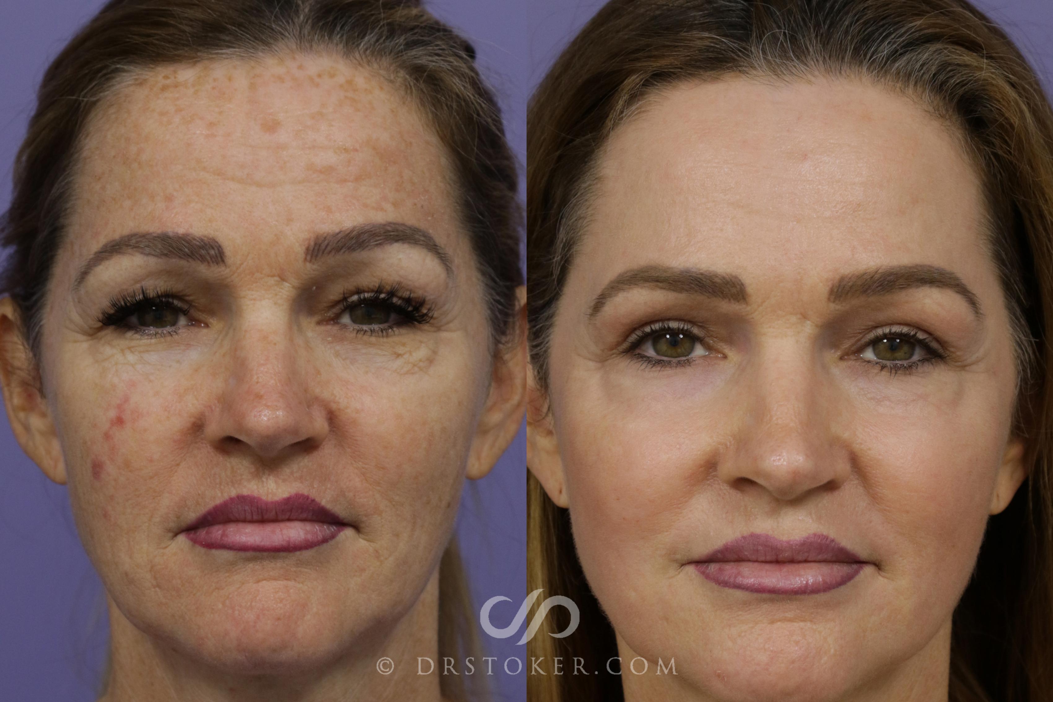 Before & After Laser Skin Resurfacing Case 1447 View #1 View in Los Angeles, CA