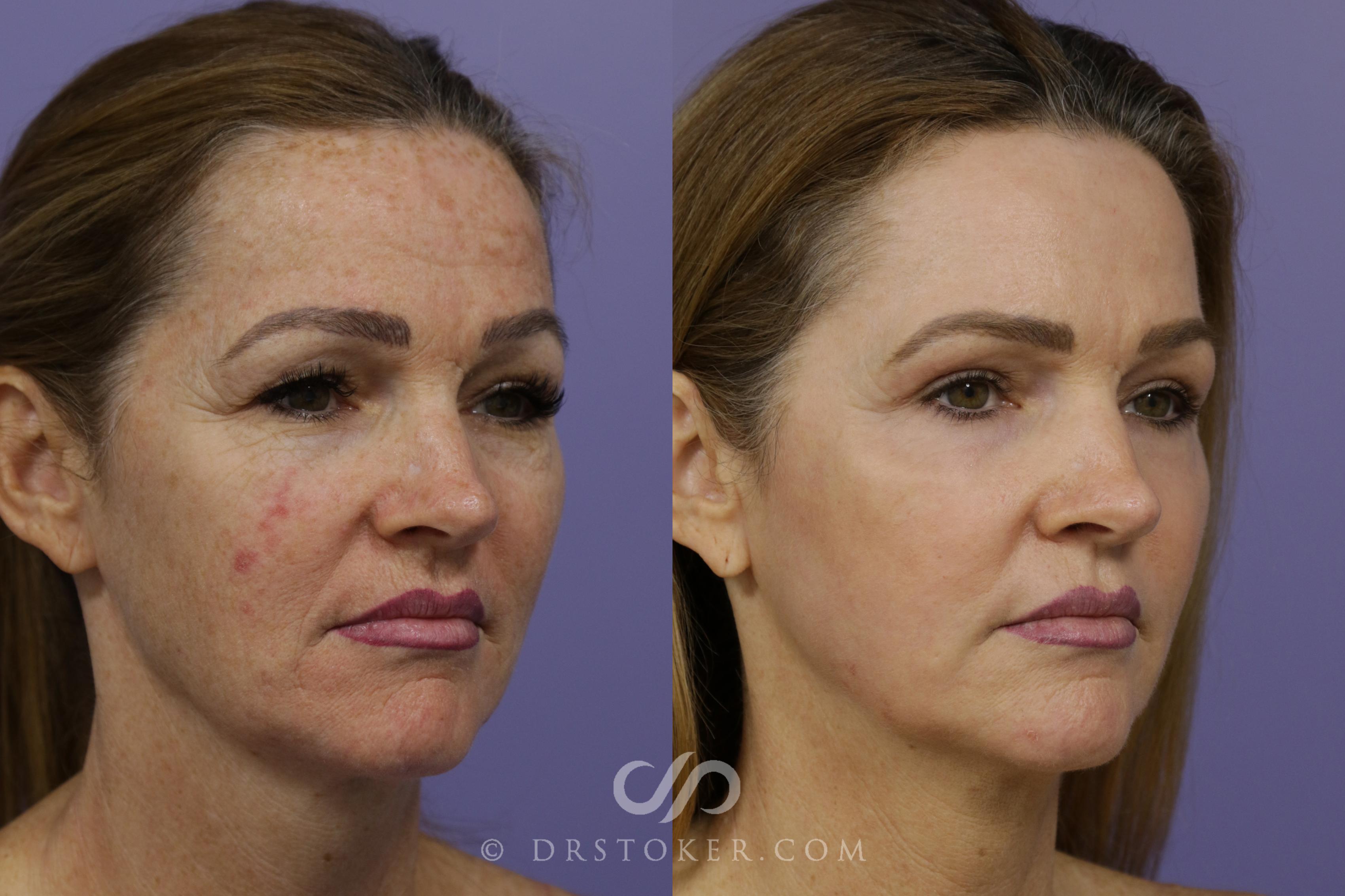 Before & After Laser Skin Resurfacing Case 1447 View #3 View in Los Angeles, CA