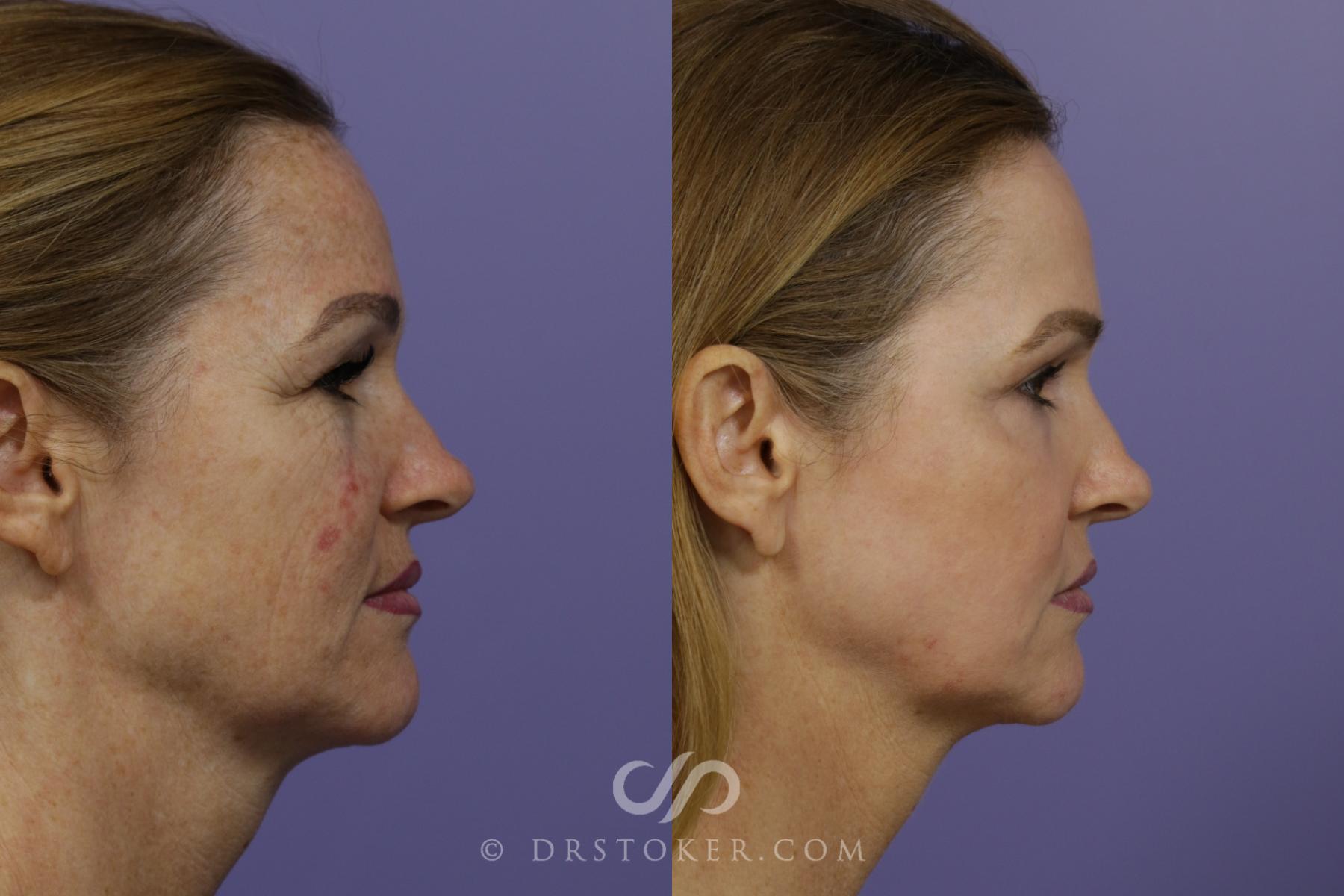 Before & After Laser Skin Resurfacing Case 1447 View #4 View in Los Angeles, CA
