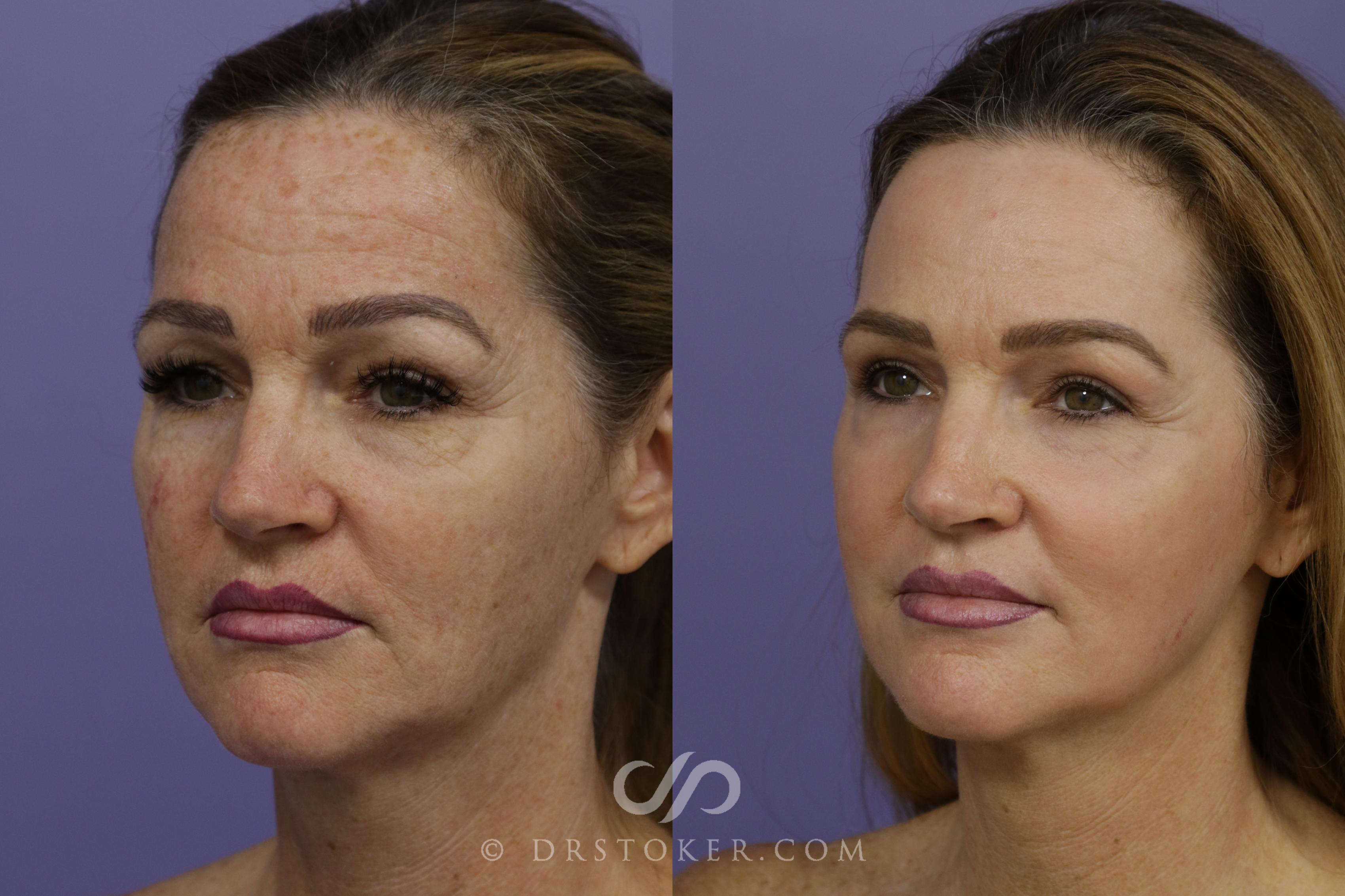 Before & After Laser Skin Resurfacing Case 1447 View #5 View in Los Angeles, CA