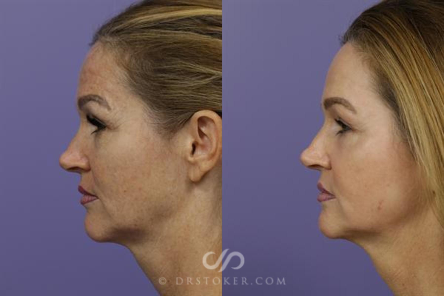 Before & After Laser Skin Resurfacing Case 1447 View #6 View in Los Angeles, CA