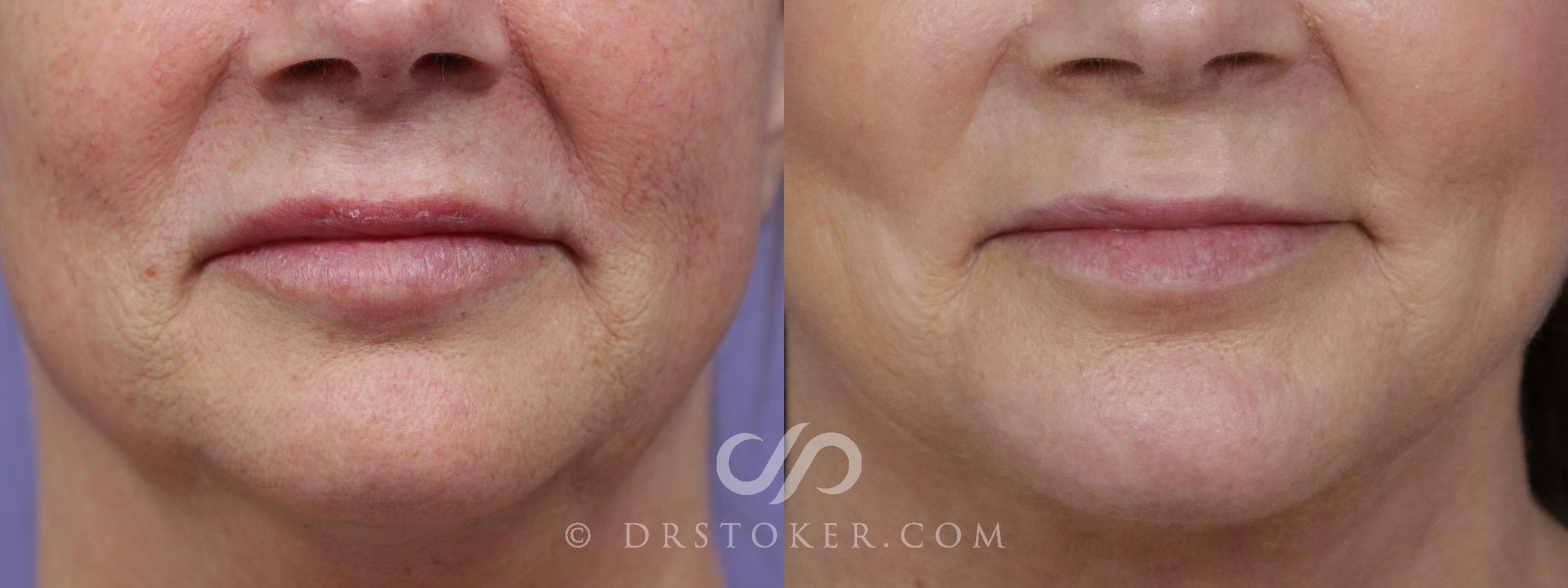 Before & After Laser Skin Resurfacing Case 1450 View #1 View in Los Angeles, CA