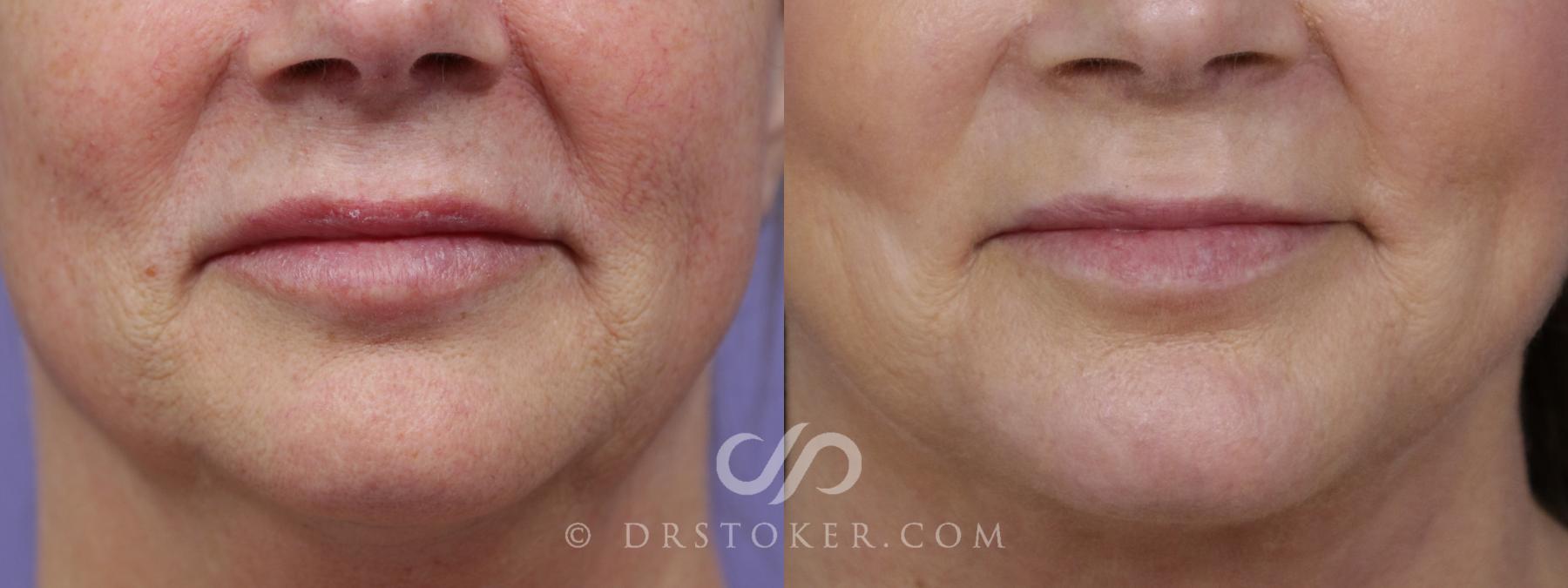 Before & After Laser Skin Resurfacing Case 1450 View #1 View in Los Angeles, CA